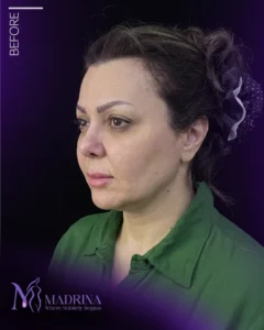 فیس لیفت - قبل از درمان