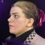 تصویر بعد از درمان