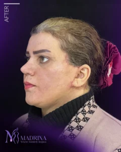 فیس لیفت - بعد از درمان