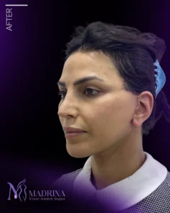 فیس لیفت - بعد از درمان