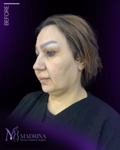 فیس لیفت - قبل از درمان